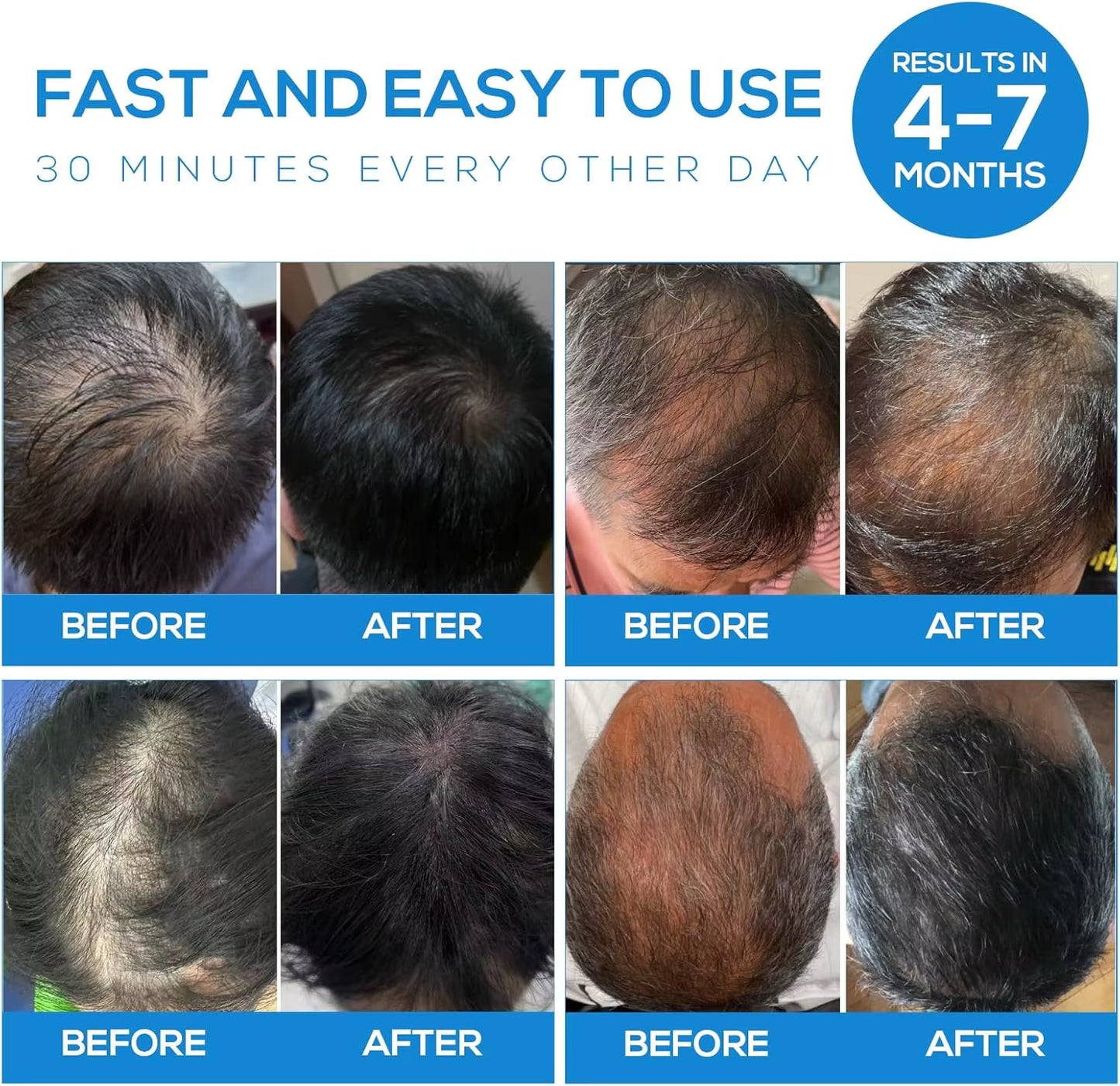 266 Laser Hair Growth Cap LLLT Therapy Red Light Scalp Health Device with Travel Bag for Hair Regrowth and Scalp Care